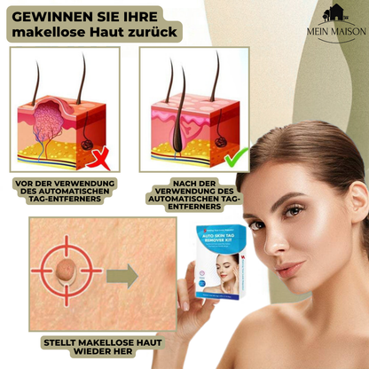 DermaLinx Warzenentferner – Bild 5 von 9