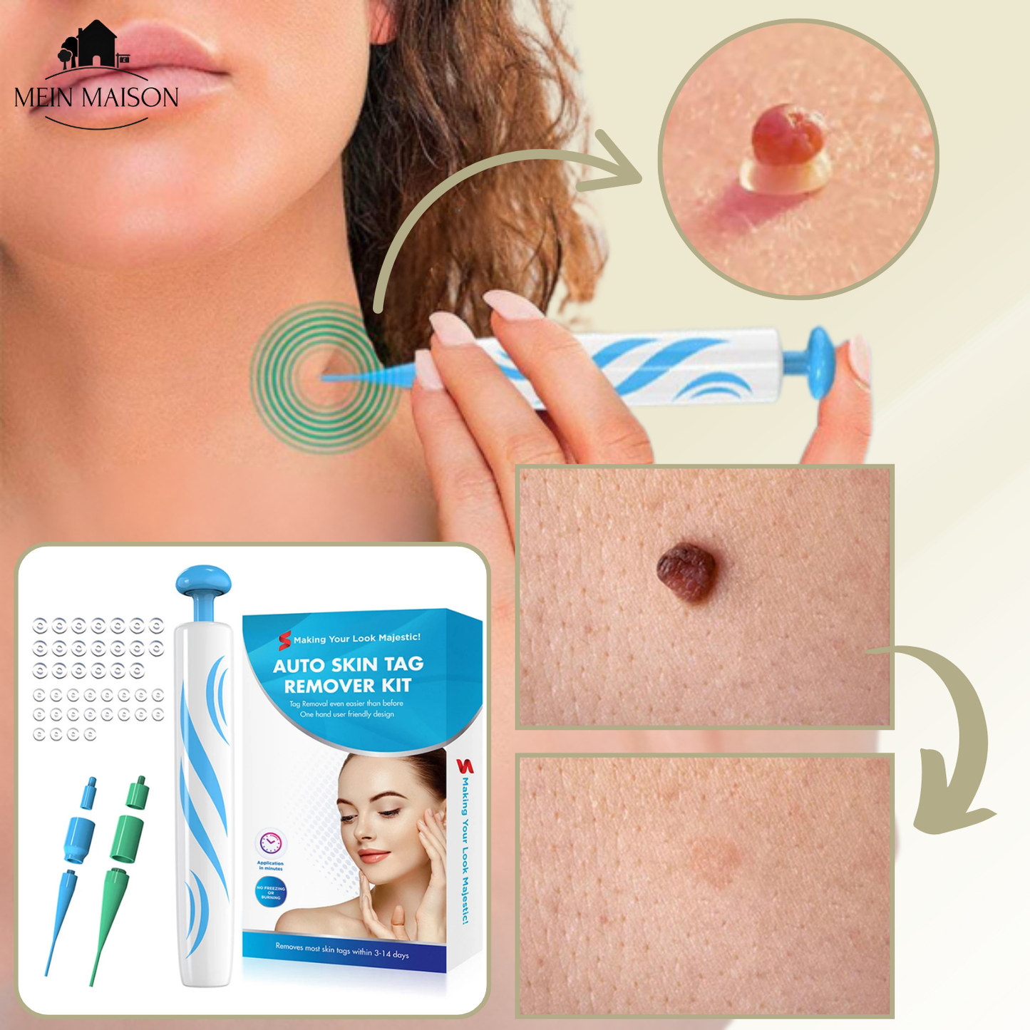 DermaLinx Warzenentferner – Bild 6 von 9