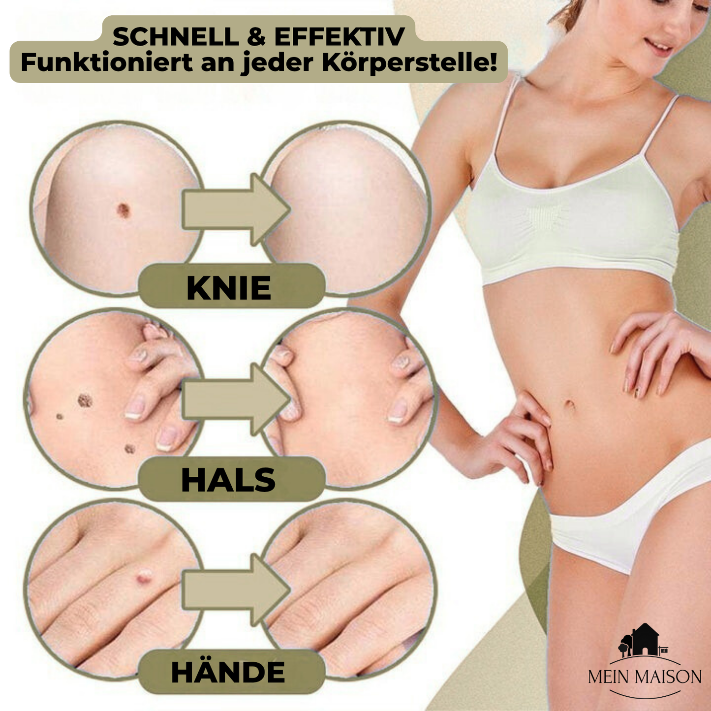 DermaLinx Warzenentferner – Bild 4 von 9