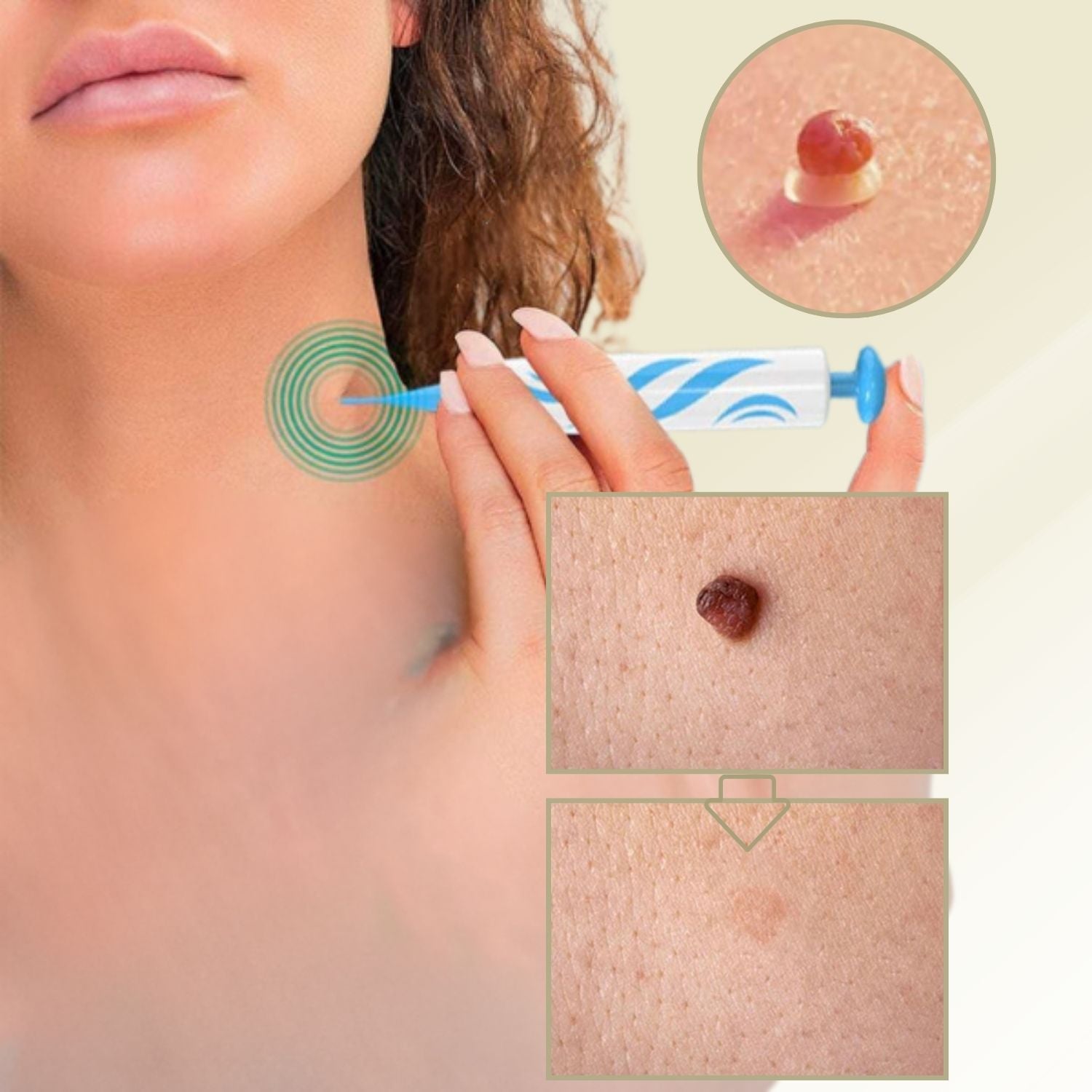 DermaLinx Warzenentferner| Schmerzfreie Entfernung von Warzen & Muttermalen| Für Zuhause| Ohne OP – Gesundheit & Wellness