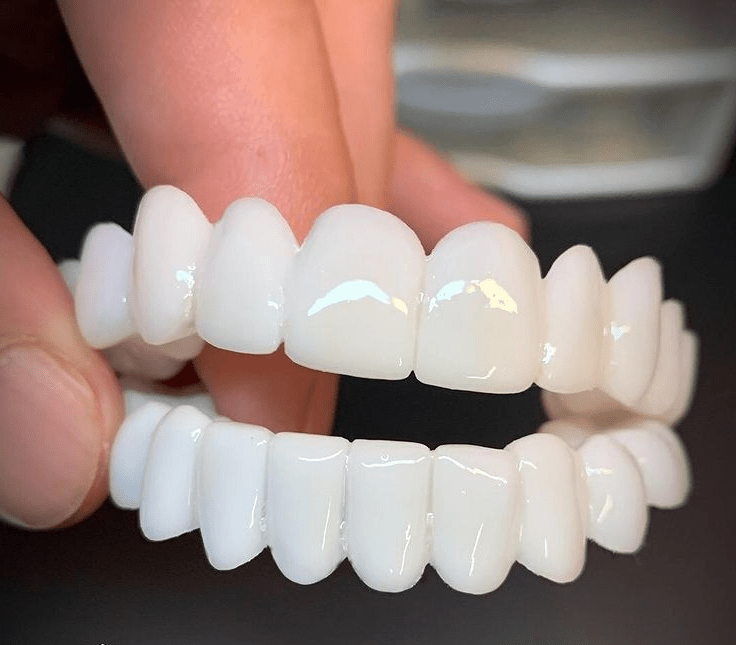 SmileFlex - Anpassbare Zahnprothese mit Dental-Linsen – Bild 5 von 5