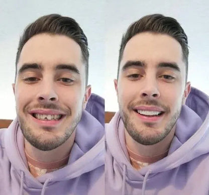 Zahnveneers – Pelanva – Ansicht 3